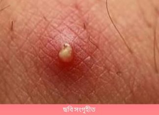 ত্বকে বিষফোঁড়া হওয়ার কারণ ও সমাধান